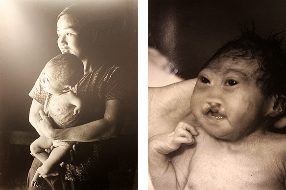 Left: 25-year-old Le Thi Thay and her 10-month-old child whose only arm was deformed and the skin beset with rash. Le had been exposed to Agent Orange at age 12; Right: A baby girl born with deformed brain, mouth, ears, and limbs died on the very next day after birth. [War Remnants Museum, Ho Chi Minh City]